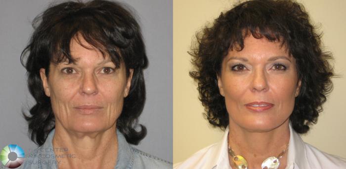 Before & After Mini Facelift Case 287 View #1 in Denver, CO