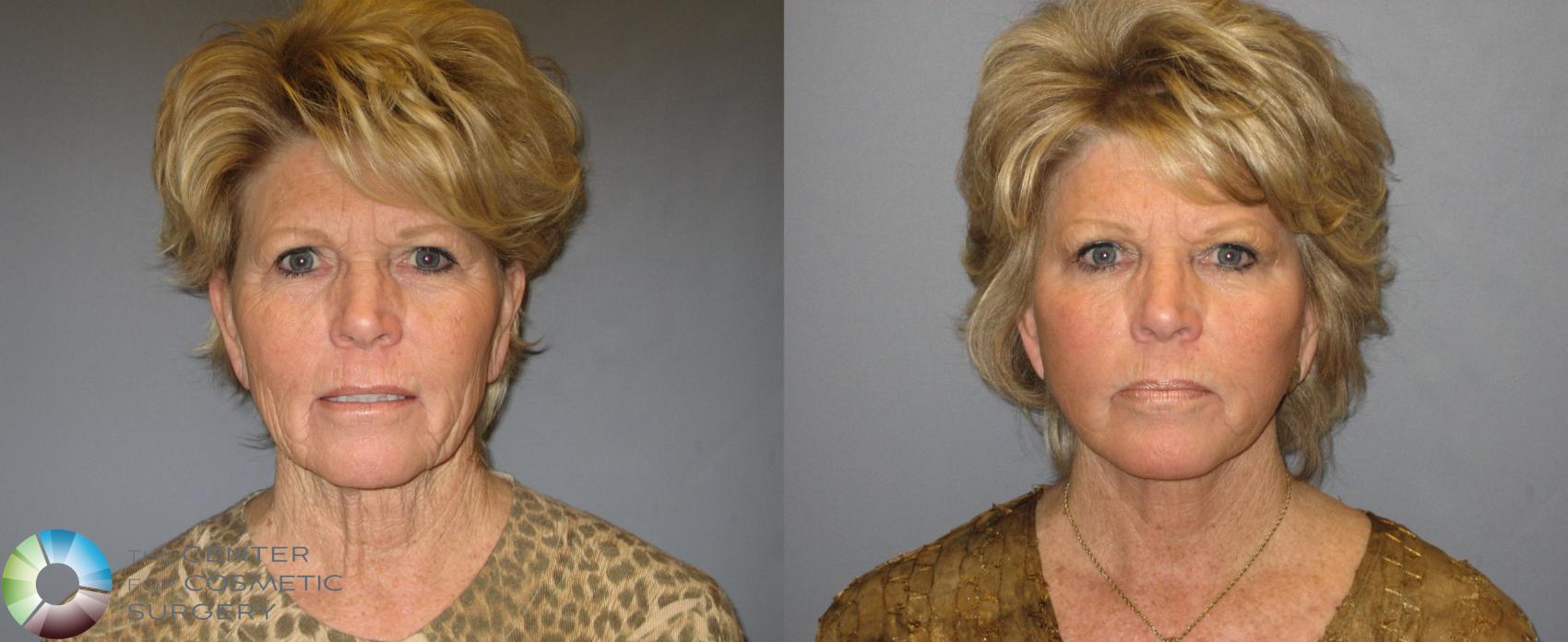 Before & After Mini Facelift Case 334 View #1 in Denver, CO