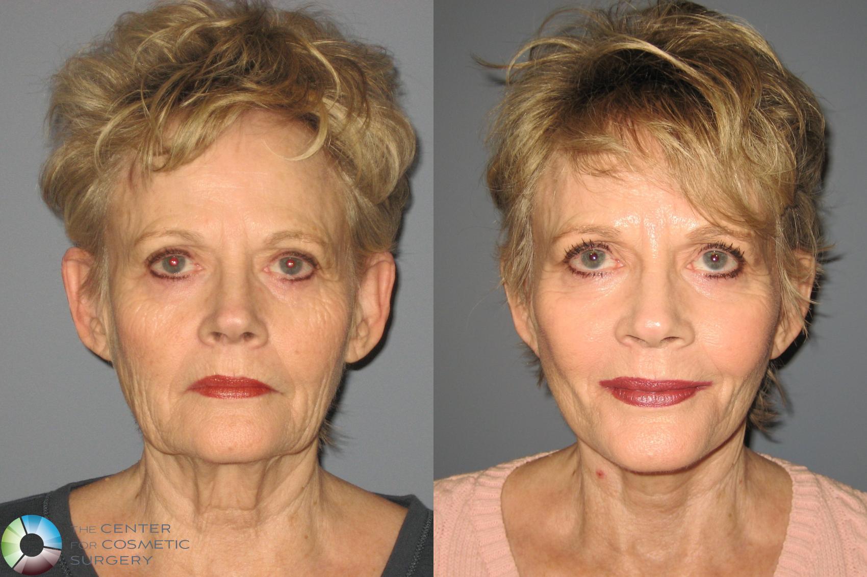 Before & After Mini Facelift Case 453 View #1 in Denver and Colorado Springs, CO