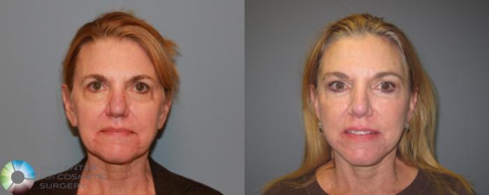 Before & After Laser Skin Resurfacing Case 459 View #1 in Denver and Colorado Springs, CO