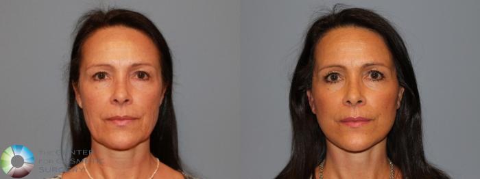 Before & After Mini Facelift Case 464 View #1 in Denver, CO