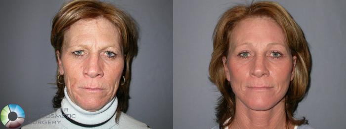Before & After Eyelid Lift Case 65 View #1 in Denver and Colorado Springs, CO