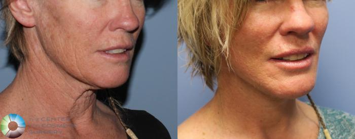 Before & After Neck Lift Case 771 View #2 in Denver, CO