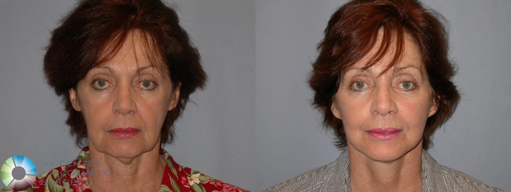 Before & After Mini Facelift Case 96 View #1 in Denver, CO