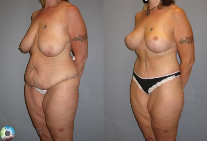 Before & After Thigh Lift Case 112 View #1 in Denver, CO