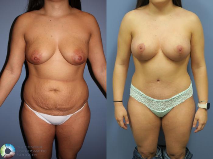 Before & After Tummy Tuck Case 11313 Front in Denver, CO