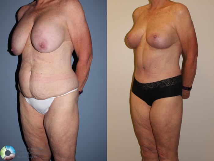 Before & After Body Lift Case 11374 Left Oblique in Denver and Colorado Springs, CO