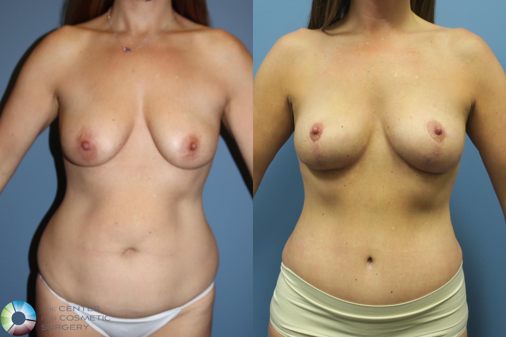Before & After Mommy Makeover Case 11737 Front in Denver and Colorado Springs, CO