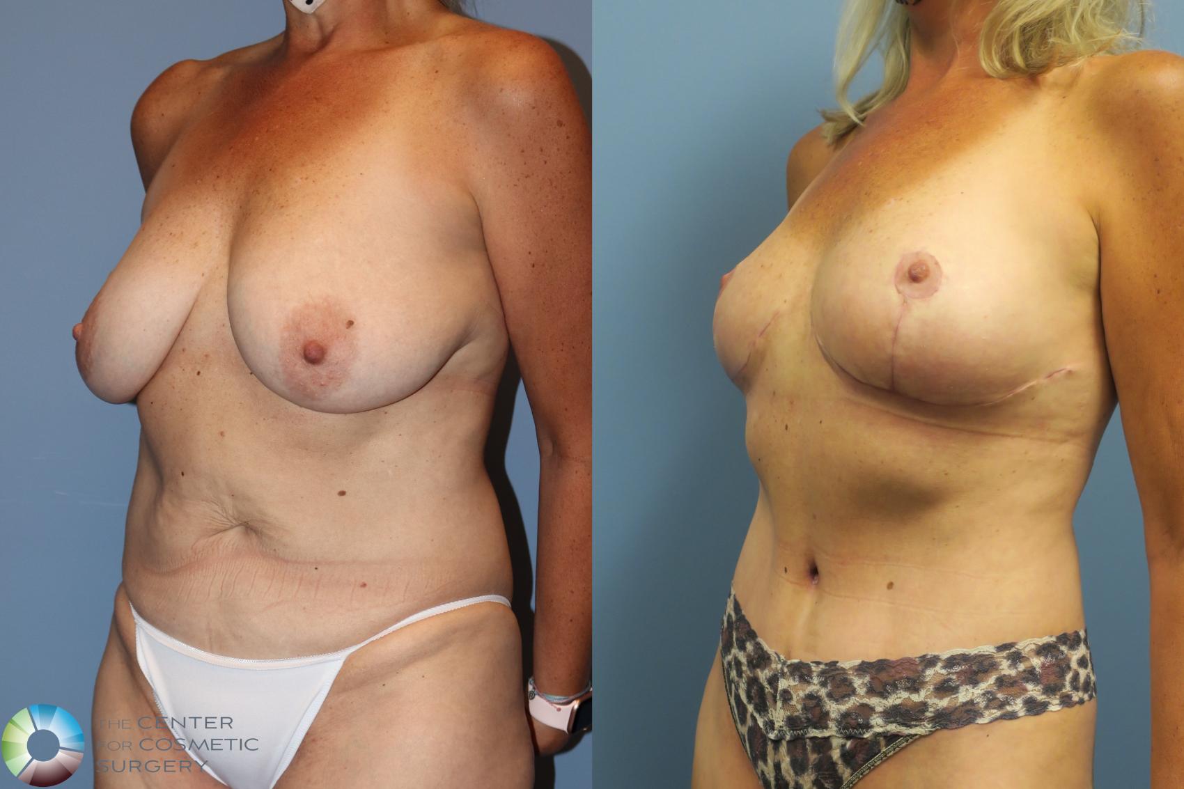 Before & After Mommy Makeover Case 11738 Left Oblique in Denver and Colorado Springs, CO