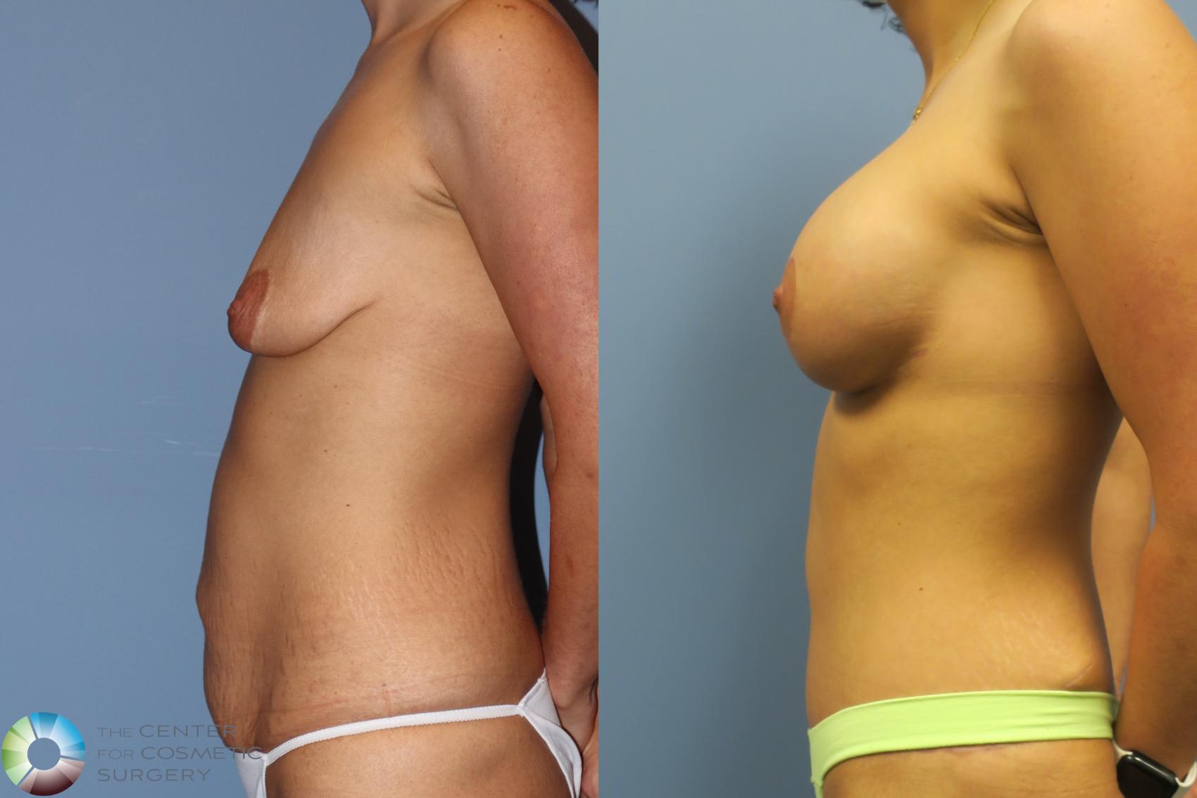 Before & After Mommy Makeover Case 11739 Left Side in Denver and Colorado Springs, CO