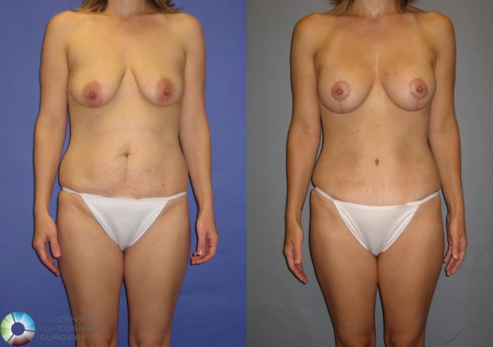 Before & After Breast Lift Case 299 View #1 in Denver, CO