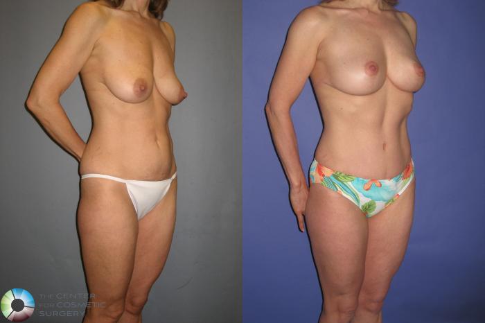 Before & After Breast Reduction Case 367 View #1 in Denver, CO