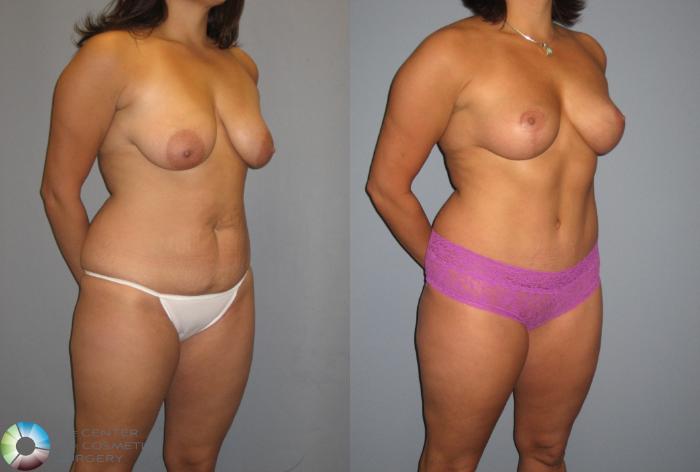 Before & After Breast Lift without Implants Case 392 View #2 in Denver, CO