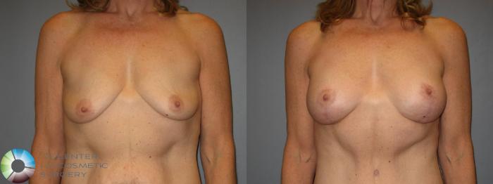 Before & After Power-assisted Liposuction Case 428 View #1 in Denver, CO