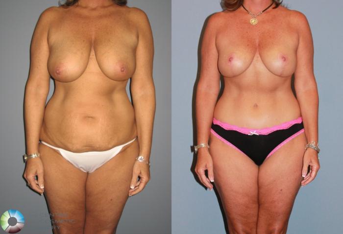 Before & After Breast Lift Case 470 View #1 in Denver, CO