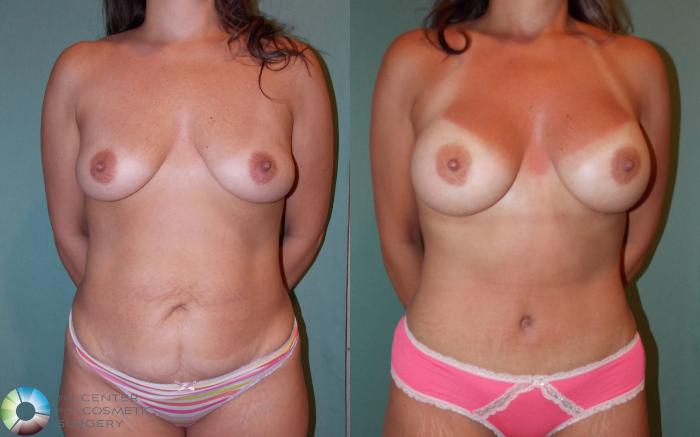 Before & After Tummy Tuck Case 683 View #1 in Denver, CO