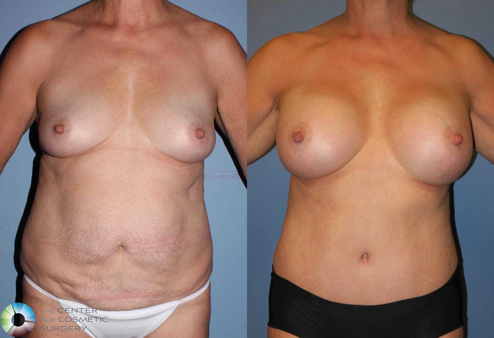 Mommy Makeover Case 944 Before & After View #1 | Golden, CO | The Center for Cosmetic Surgery