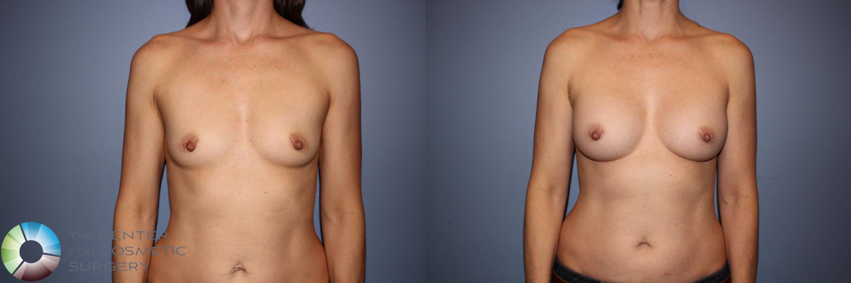 Before & After Motiva Implants® Case 12145 Front in Denver and Colorado Springs, CO