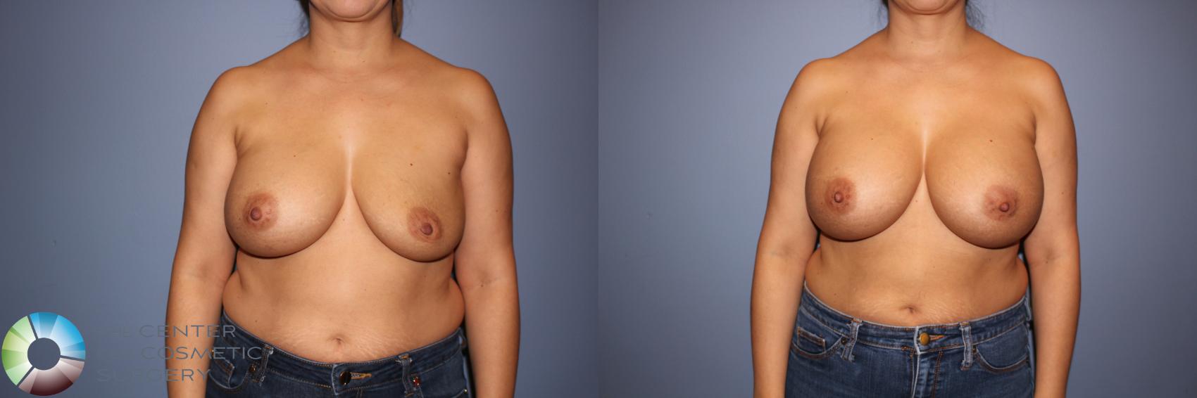 Before & After Motiva Implants® Case 12147 Front in Denver and Colorado Springs, CO