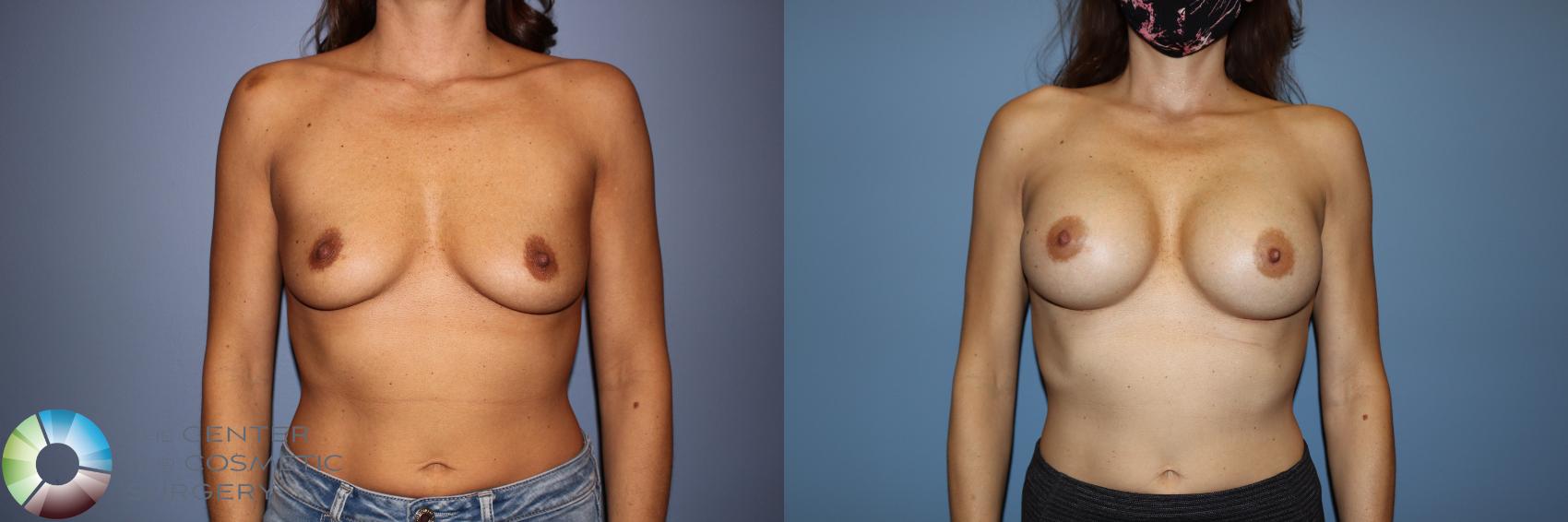 Before & After Motiva Implants® Case 12148 Front in Denver and Colorado Springs, CO
