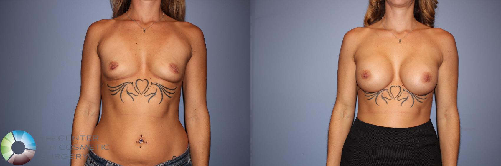 Before & After Motiva Implants® Case 12150 Front in Denver and Colorado Springs, CO