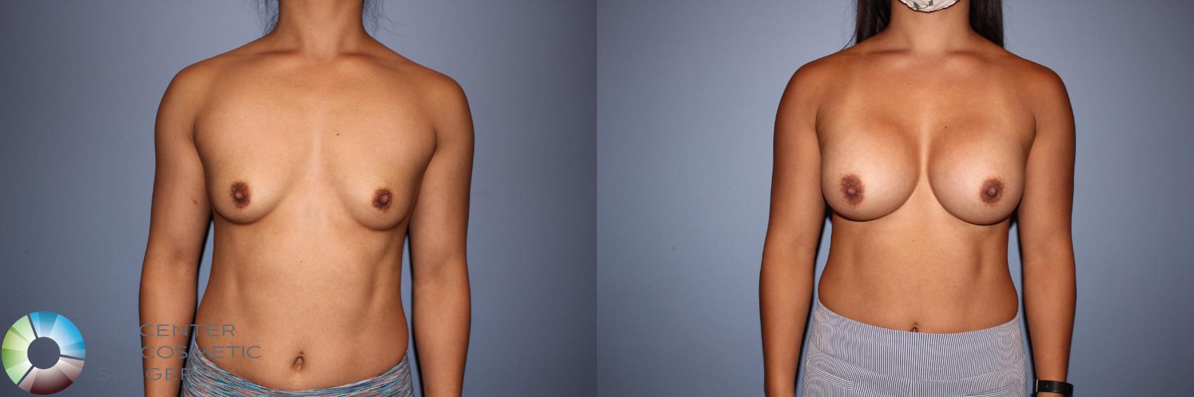Before & After Motiva Implants® Case 12152 Front in Denver and Colorado Springs, CO