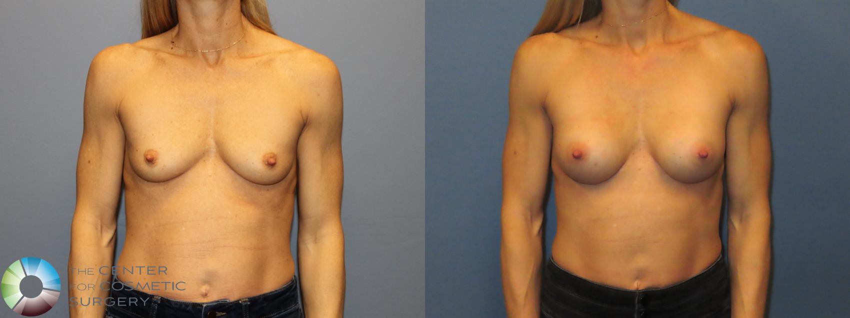Before & After Small Implant Breast Augmentation (Breast Preservation) Case 12175 Front in Denver and Colorado Springs, CO
