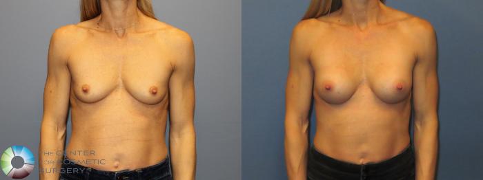 Before & After Small Implant Breast Augmentation (Breast Preservation) Case 12175 Front in Denver and Colorado Springs, CO