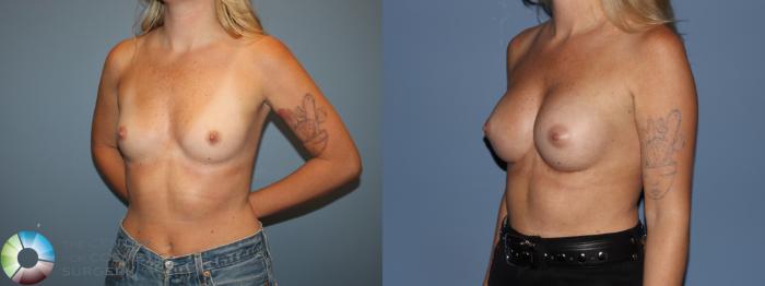 Before & After Small Implant Breast Augmentation (Breast Preservation) Case 12176 Right Oblique in Denver and Colorado Springs, CO