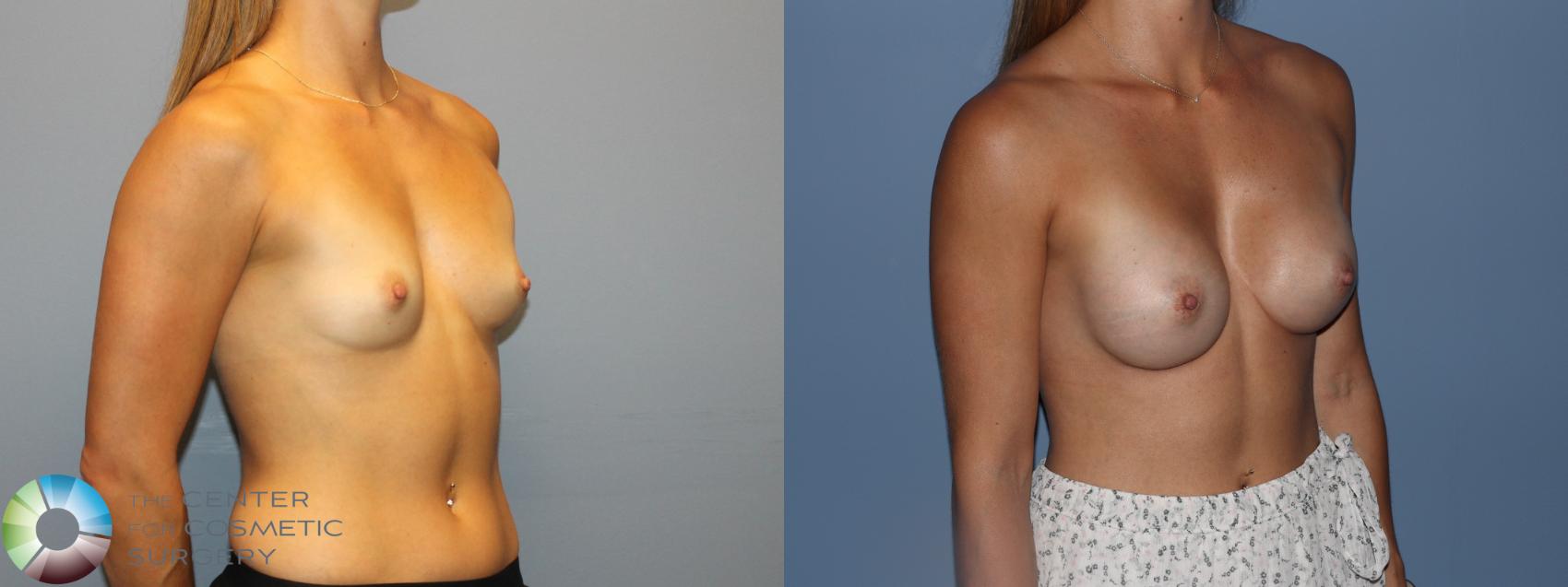 Before & After Small Implant Breast Augmentation (Breast Preservation) Case 12177 Left Oblique in Denver and Colorado Springs, CO