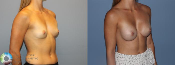 Before & After Small Implant Breast Augmentation (Breast Preservation) Case 12177 Left Oblique in Denver and Colorado Springs, CO