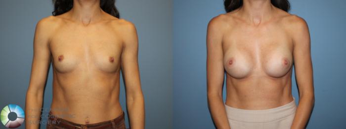 Before & After Small Implant Breast Augmentation (Breast Preservation) Case 12178 Front in Denver and Colorado Springs, CO