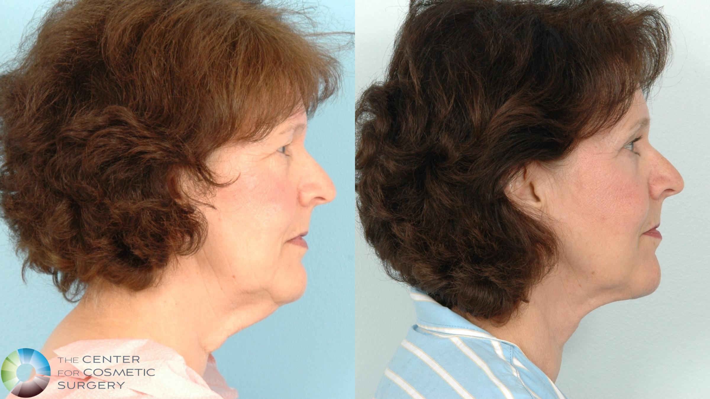 Before & After Facelift Case 11842 Right Side View in Golden, CO