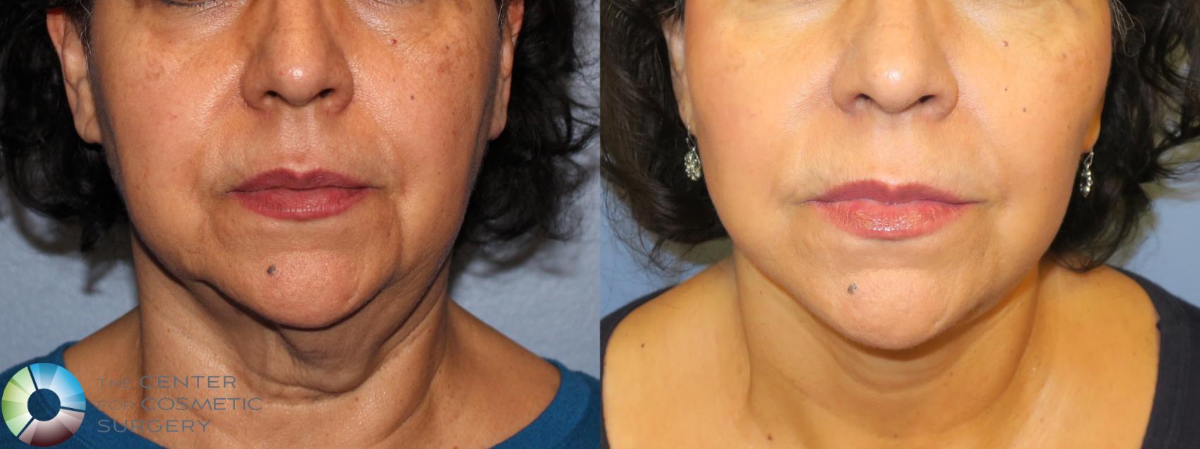 Before & After Neck Lift Case 898 View #1 in Denver, CO