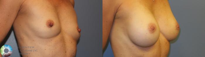 Before & After Nipple reduction Case 11216 Right Oblique in Denver, CO