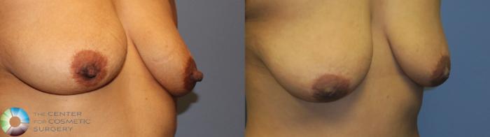 Before & After Nipple reduction Case 11344 Right Oblique in Denver, CO