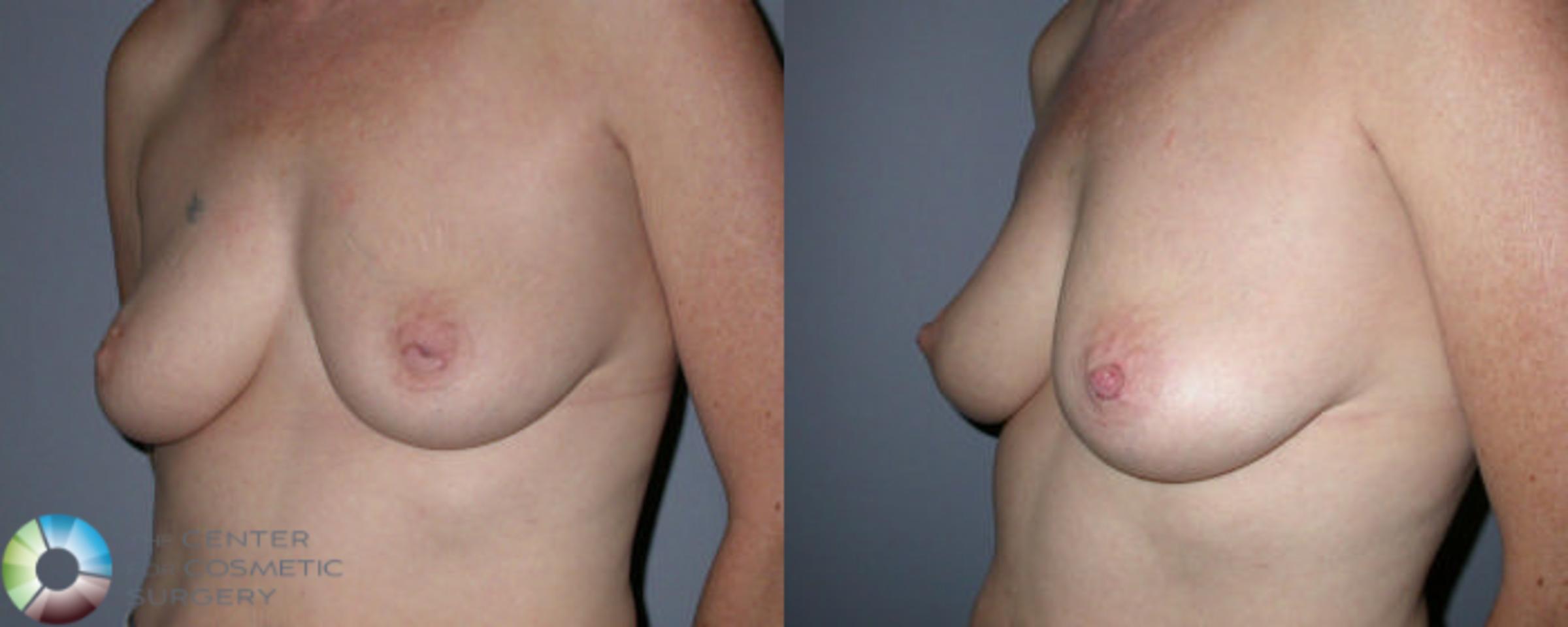 Inverted Nipple Repair Case 58 Before & After View #1 | Golden, CO | The Center for Cosmetic Surgery