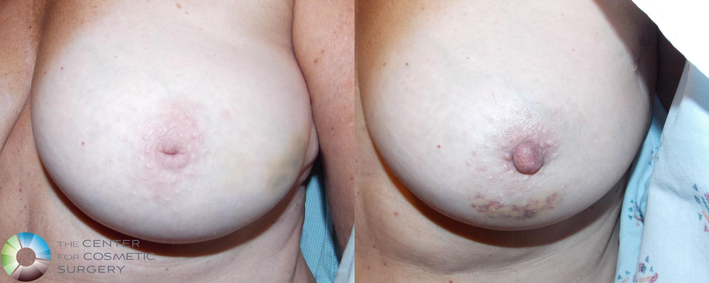 Inverted Nipple Repair Case 710 Before & After View #1 | Golden, CO | The Center for Cosmetic Surgery