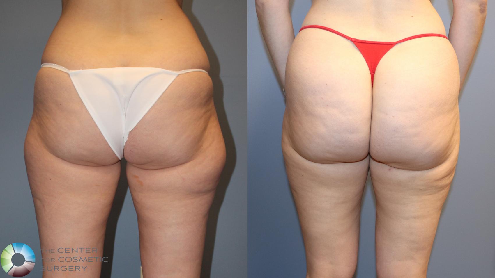 Before & After Liposuction Case 12163 Back in Denver and Colorado Springs, CO