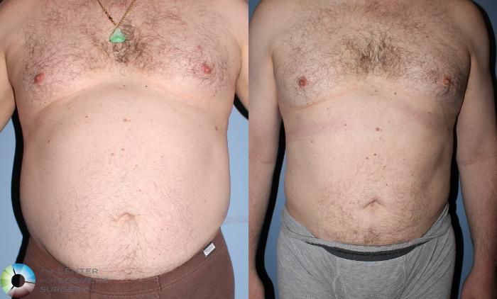Before & After Liposuction Case 825 View #1 in Denver, CO