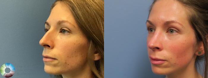 Before & After Rhinoplasty Case 11548 Left Oblique in Denver and Colorado Springs, CO