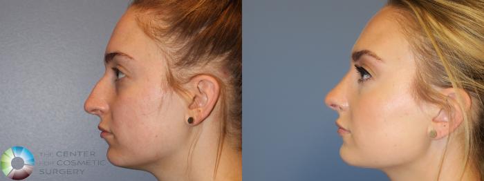 Before & After Rhinoplasty Case 11785 Left Side in Denver and Colorado Springs, CO