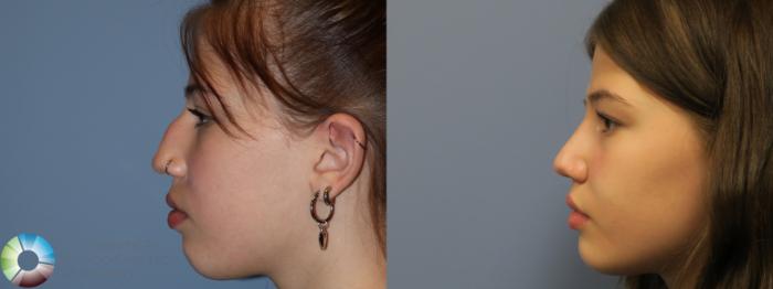 Before & After Rhinoplasty Case 11861 Left Side in Denver and Colorado Springs, CO