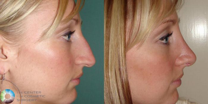 Before & After Rhinoplasty Case 501 Right Side in Denver and Colorado Springs, CO