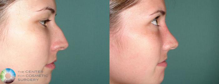 Before & After Rhinoplasty Case 655 View #1 in Denver and Colorado Springs, CO