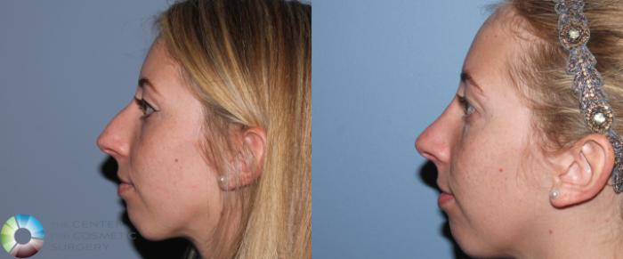 Before & After Rhinoplasty Case 788 View #1 in Denver and Colorado Springs, CO