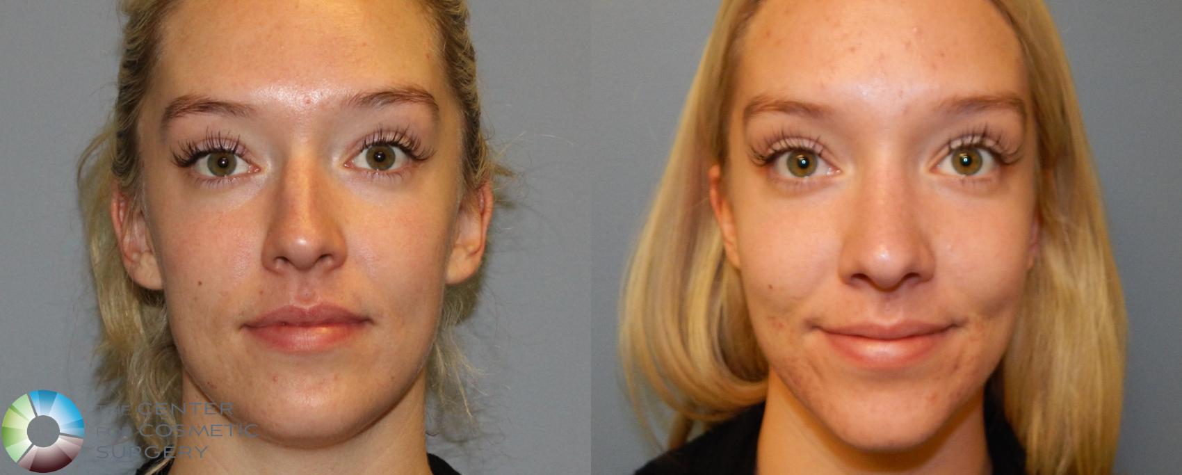 Before & After Rhinoplasty Case 841 View #1 in Denver, CO