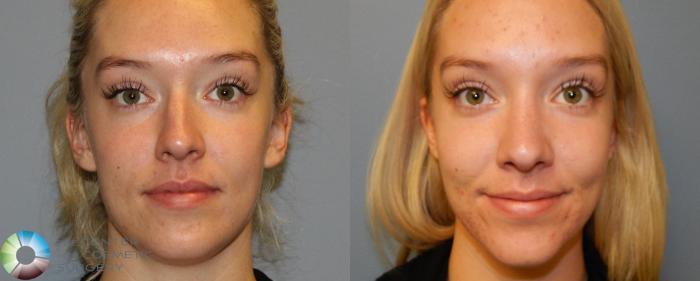 Before & After Rhinoplasty Case 841 View #1 in Denver and Colorado Springs, CO