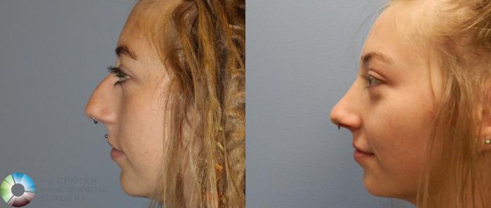 Before & After Rhinoplasty Case 979 View #1 in Denver and Colorado Springs, CO