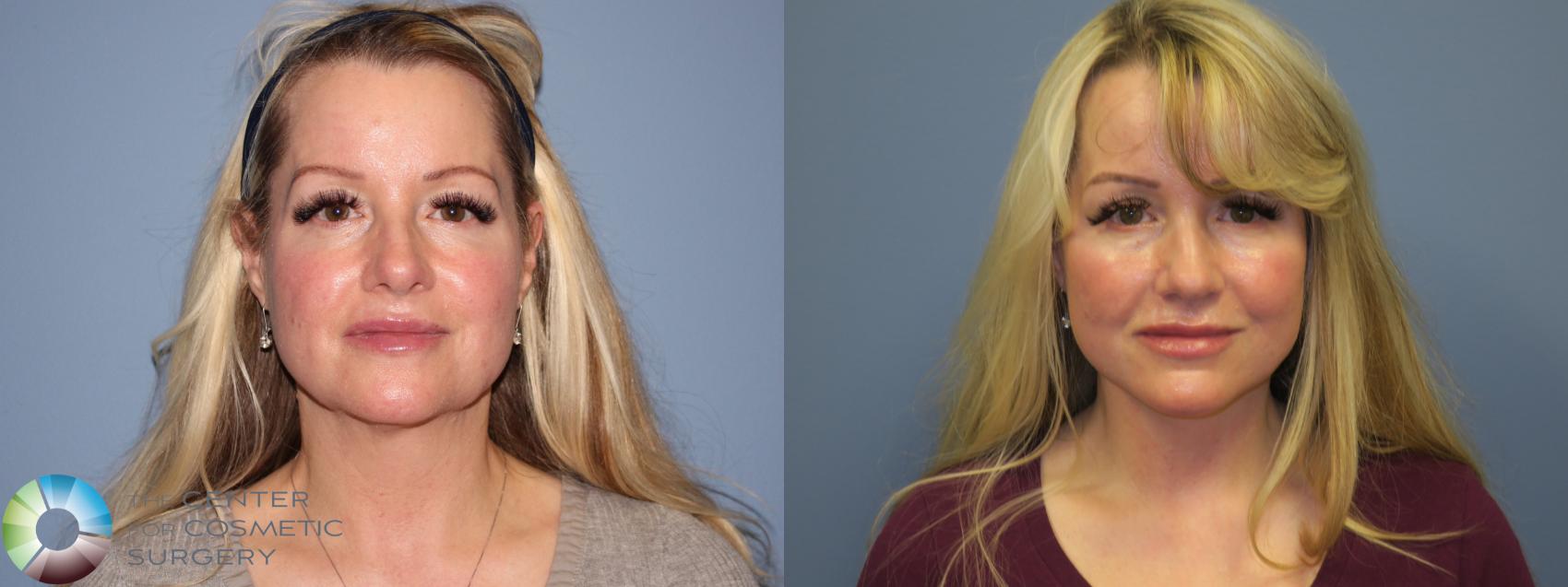 Before & After SMAS Facelift Case 12210 Front in Denver and Colorado Springs, CO